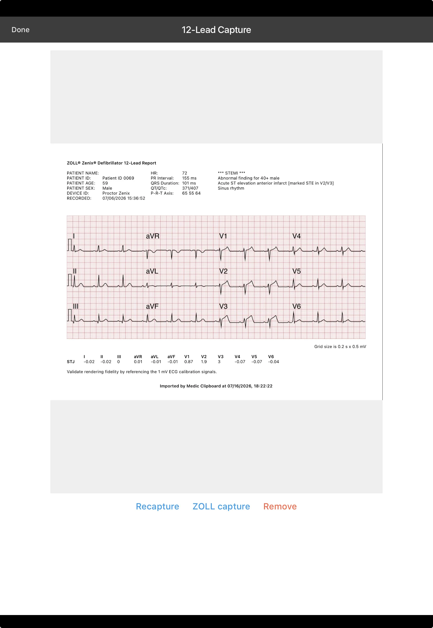 ZOLL 12-lead capture showing a STEMI read in Medic Clipboard